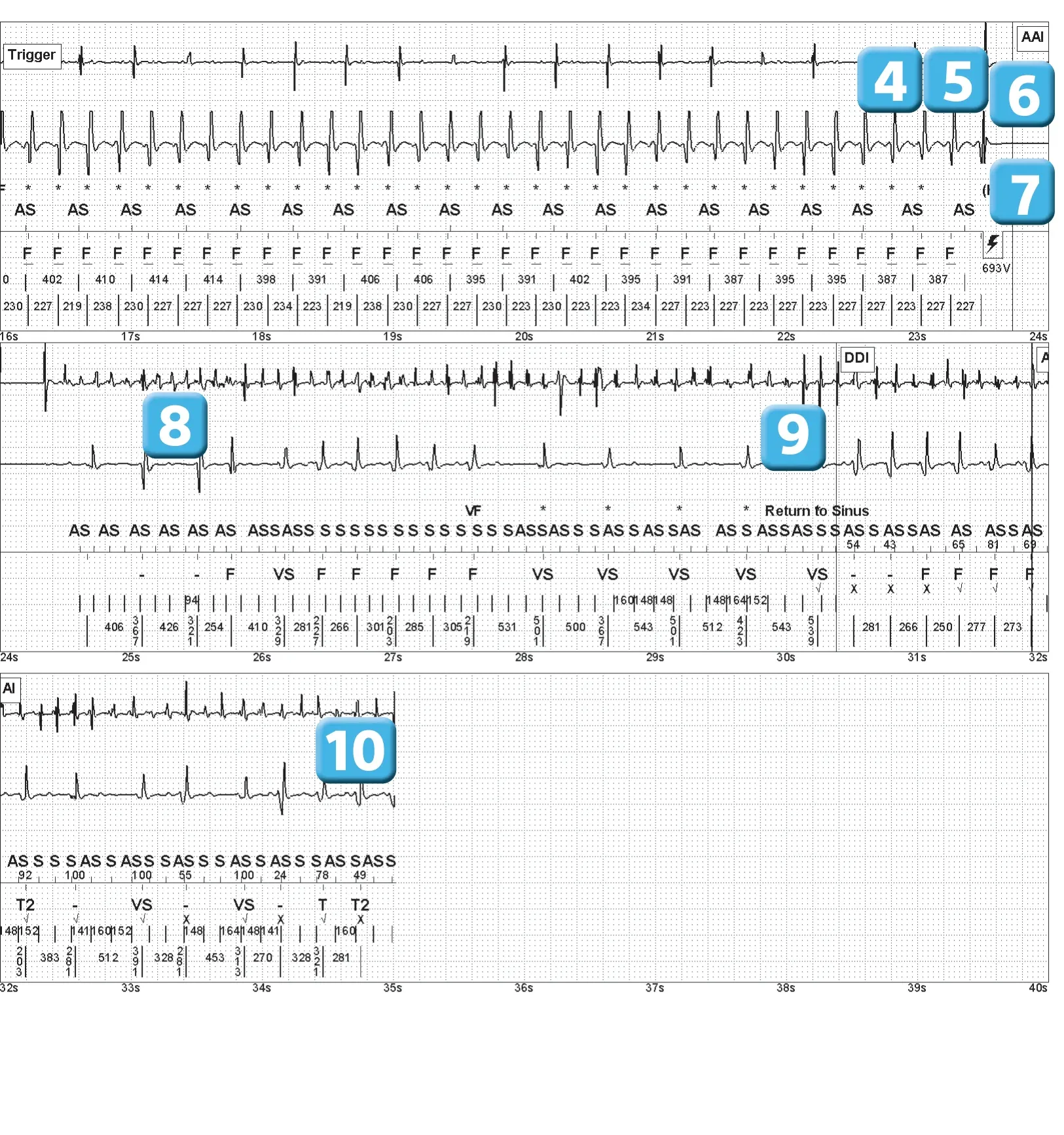 Abbott ICD electrogram, segment 3 of 3 — Electrical shock and induction of an AF episode
