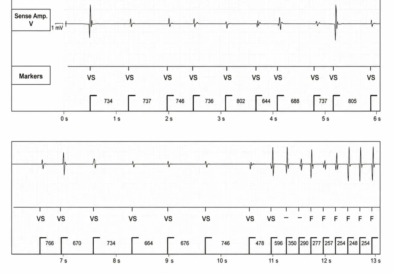 Anti-tachycardia pacing during or before charging in the VF zone