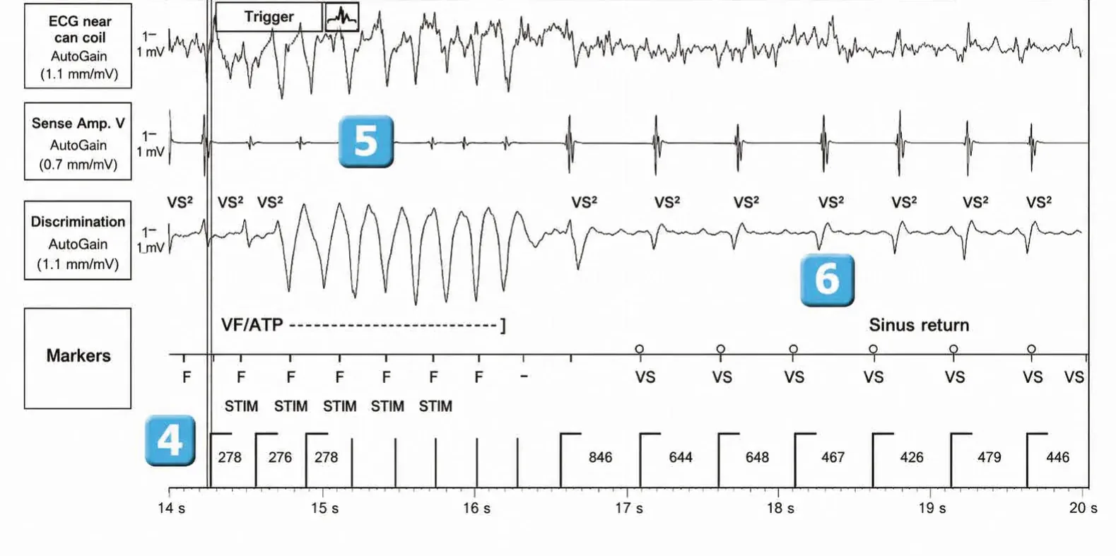 Anti-tachycardia pacing during or before charging in the VF zone