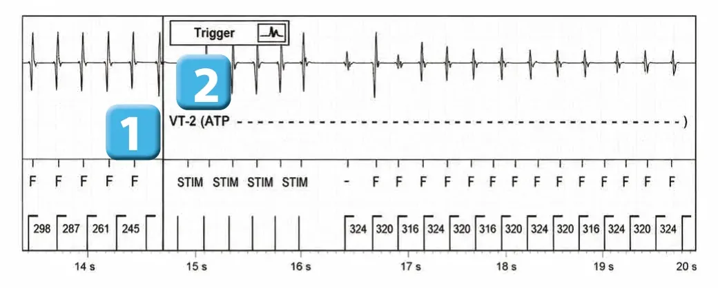 Abbott ICD electrogram, segment 1 of 3 — Anti-tachycardia pacing during or before charging in the VF zone
