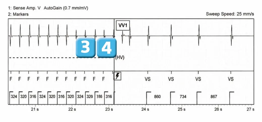 Abbott ICD electrogram, segment 2 of 3 — Anti-tachycardia pacing during or before charging in the VF zone