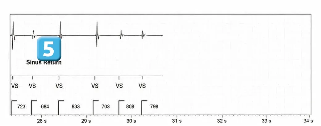 Abbott ICD electrogram, segment 3 of 3 — Anti-tachycardia pacing during or before charging in the VF zone