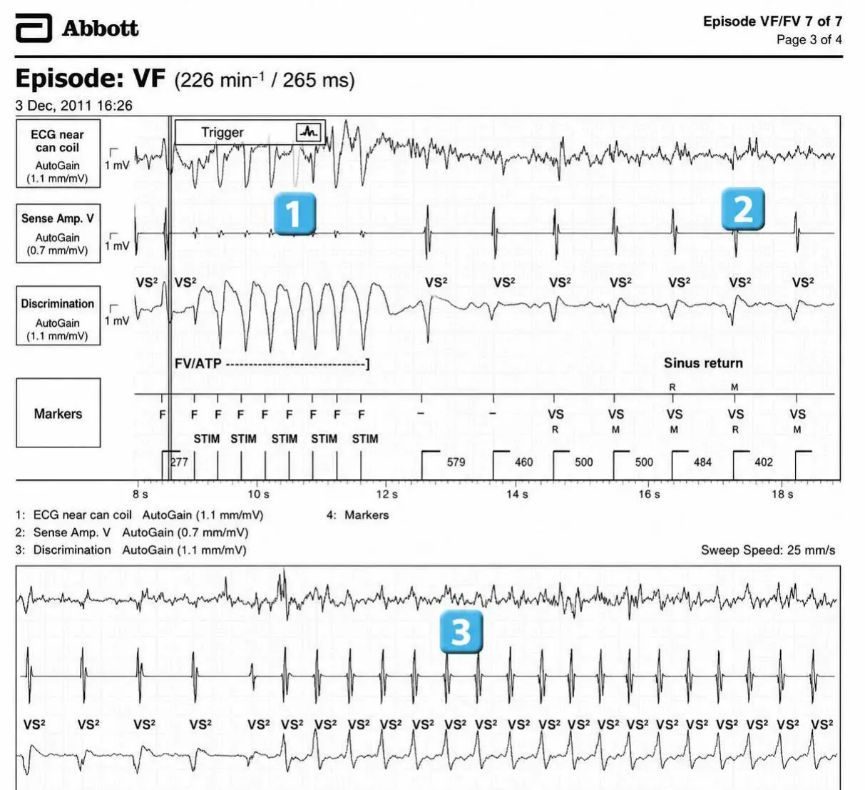 Abbott ICD electrogram, segment 1 of 1 — Anti-tachycardia pacing during or before charging in the VF zone