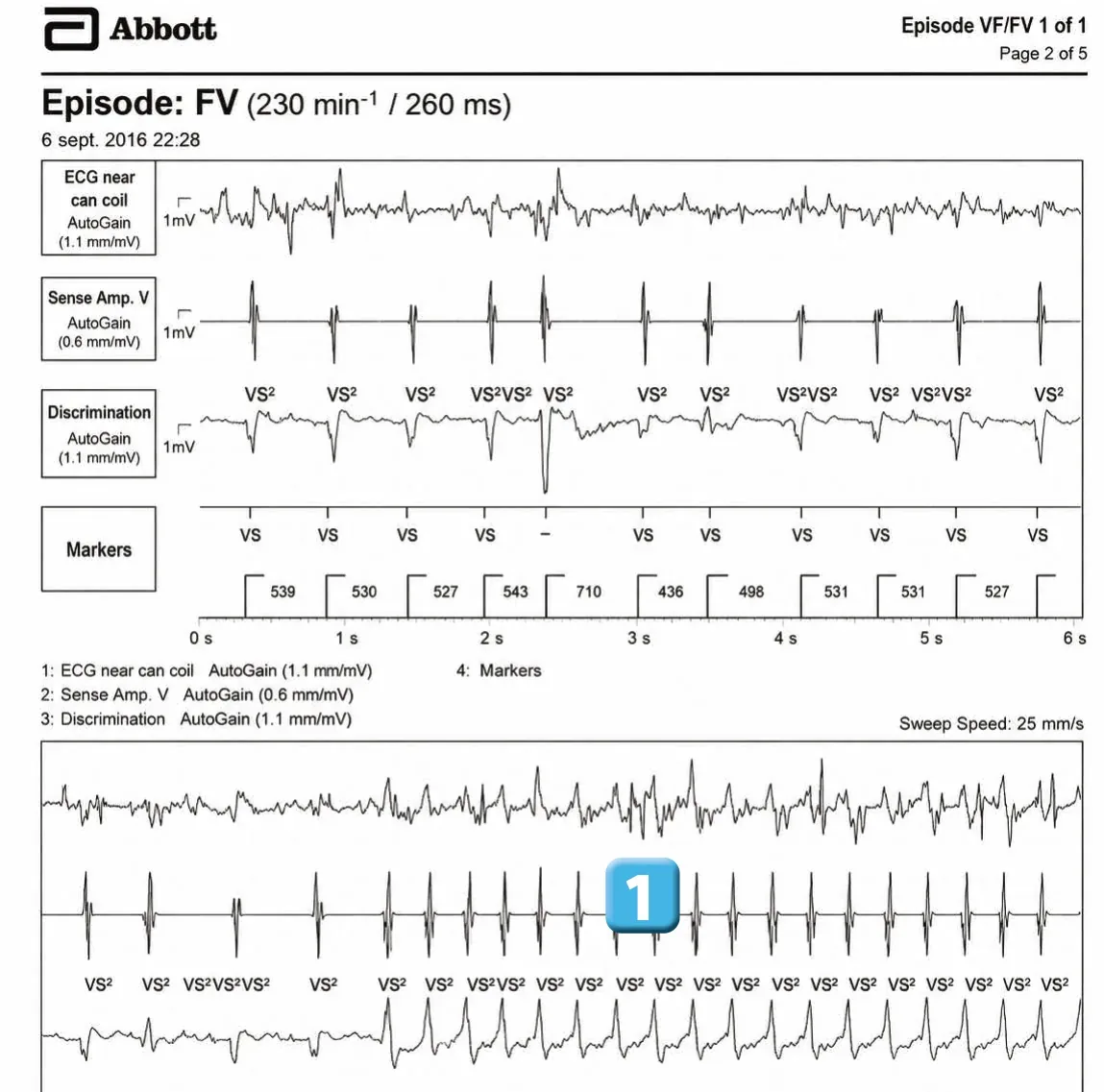Abbott ICD electrogram, segment 1 of 3 — Anti-tachycardia pacing during or before charging in the VF zone