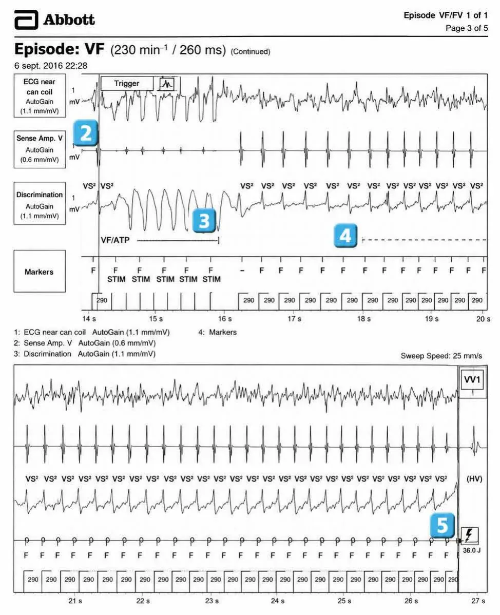 Abbott ICD electrogram, segment 2 of 3 — Anti-tachycardia pacing during or before charging in the VF zone