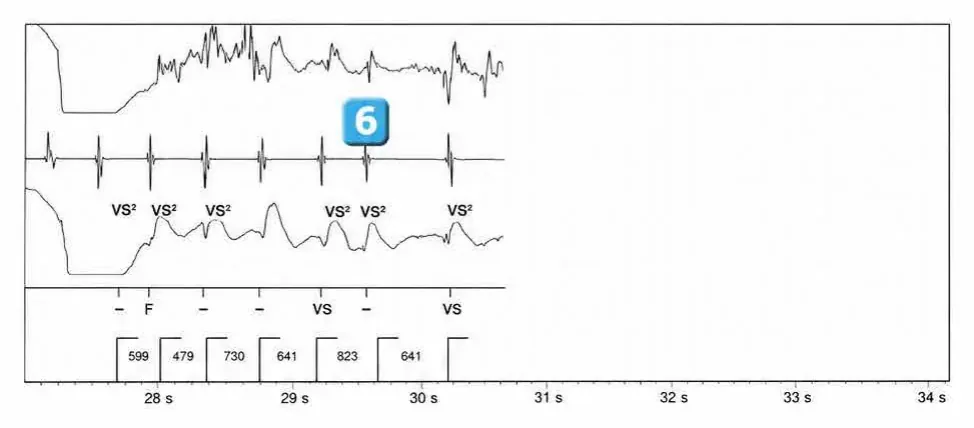 Abbott ICD electrogram, segment 3 of 3 — Anti-tachycardia pacing during or before charging in the VF zone