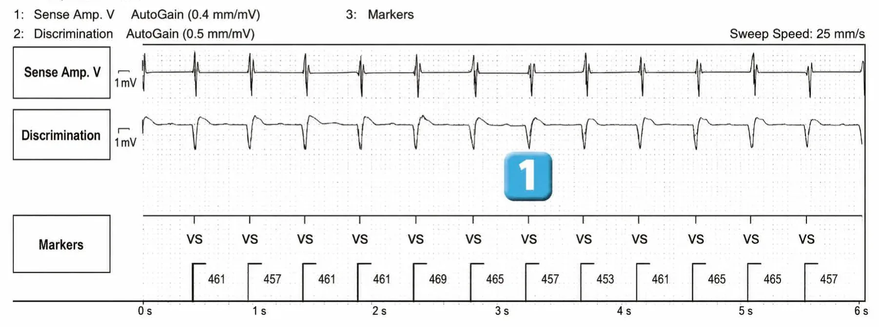 Abbott ICD electrogram, segment 1 of 4 — ATP during charging and acceleration of tachycardia