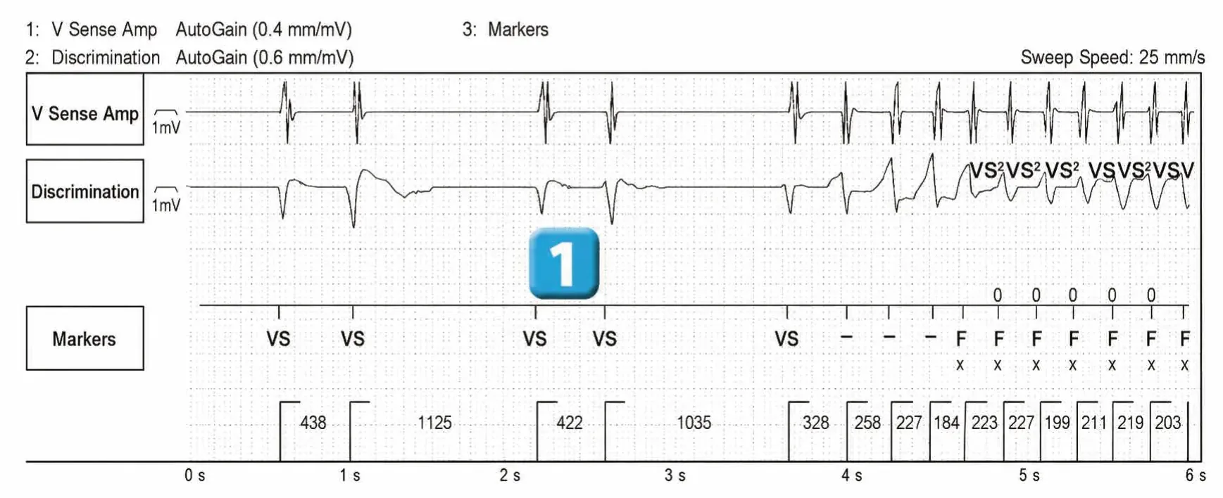 Abbott ICD electrogram, segment 1 of 2 — ATP during charging and acceleration of tachycardia