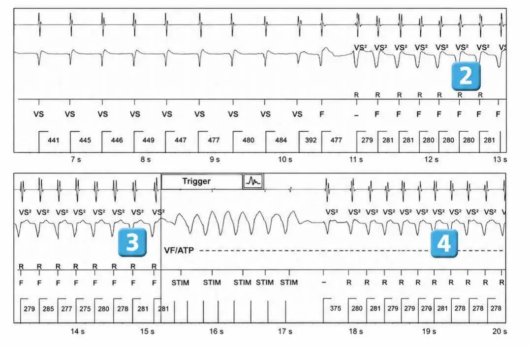 Abbott ICD electrogram, segment 2 of 4 — ATP during charging and acceleration of tachycardia