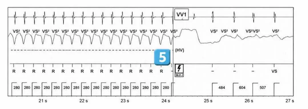 Abbott ICD electrogram, segment 3 of 4 — ATP during charging and acceleration of tachycardia