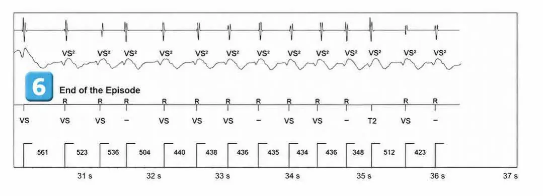Abbott ICD electrogram, segment 4 of 4 — ATP during charging and acceleration of tachycardia