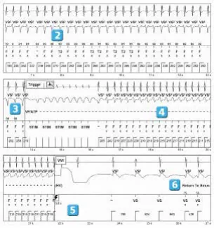 Abbott ICD electrogram, segment 2 of 2 — ATP during charging and acceleration of tachycardia