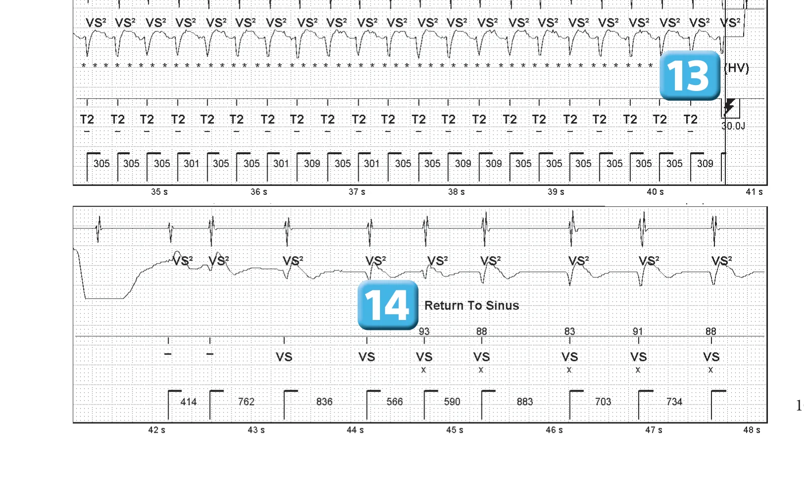 Sequence of therapies in the VT zone