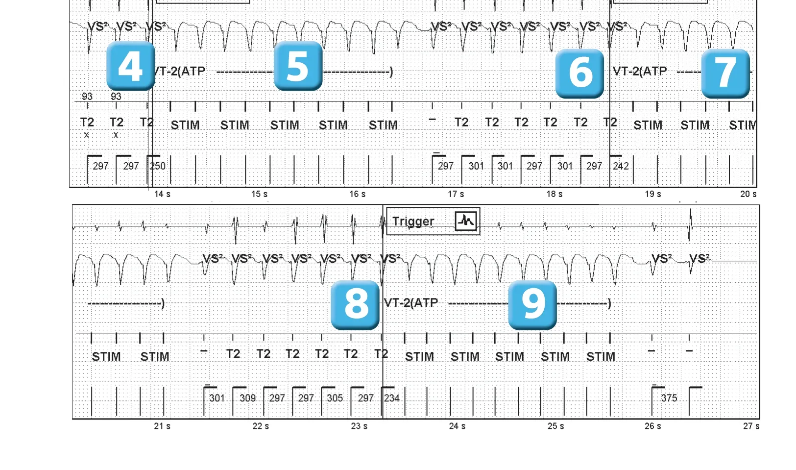 Abbott ICD electrogram, segment 1 of 2 — Sequence of therapies in the VT zone