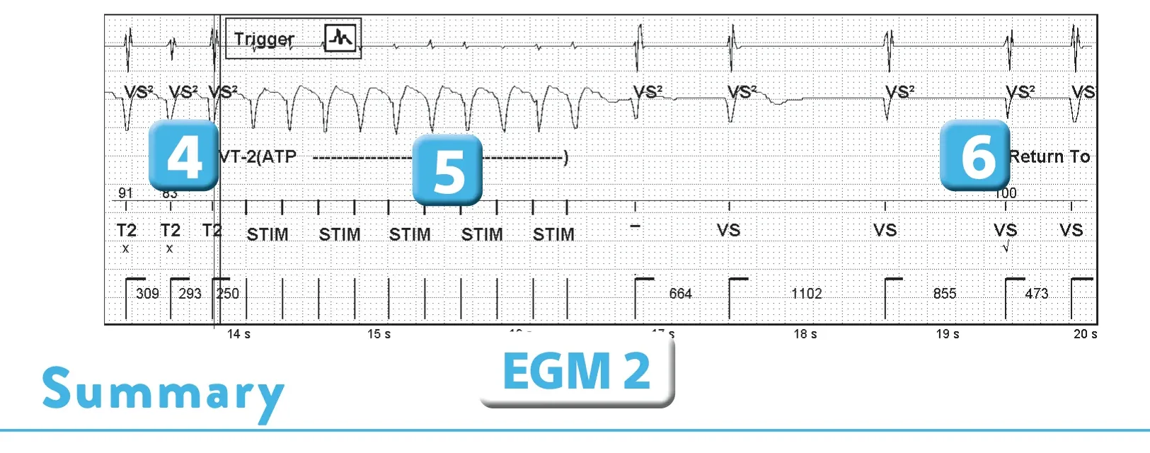 Abbott ICD electrogram, segment 2 of 2 — Sequence of therapies in the VT zone