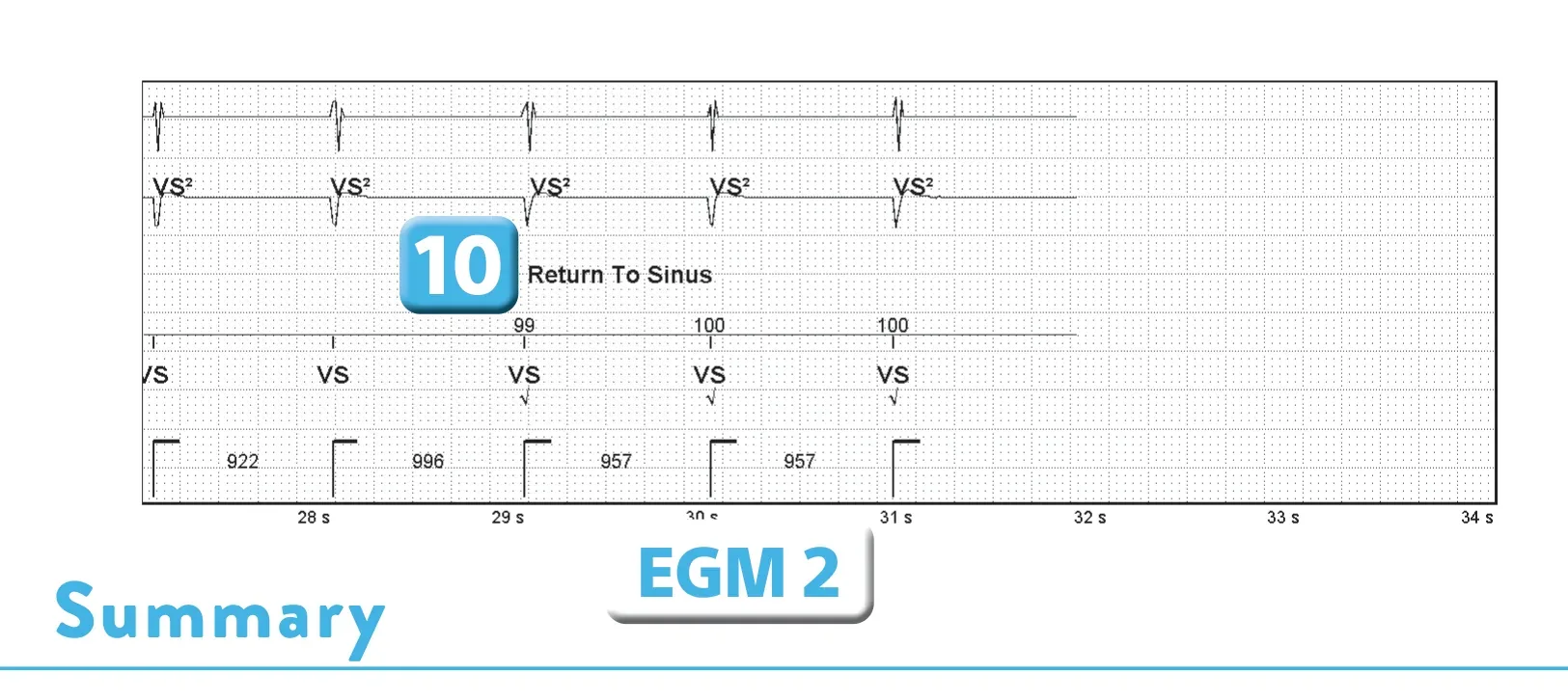 Abbott ICD electrogram, segment 2 of 2 — Sequence of therapies in the VT zone