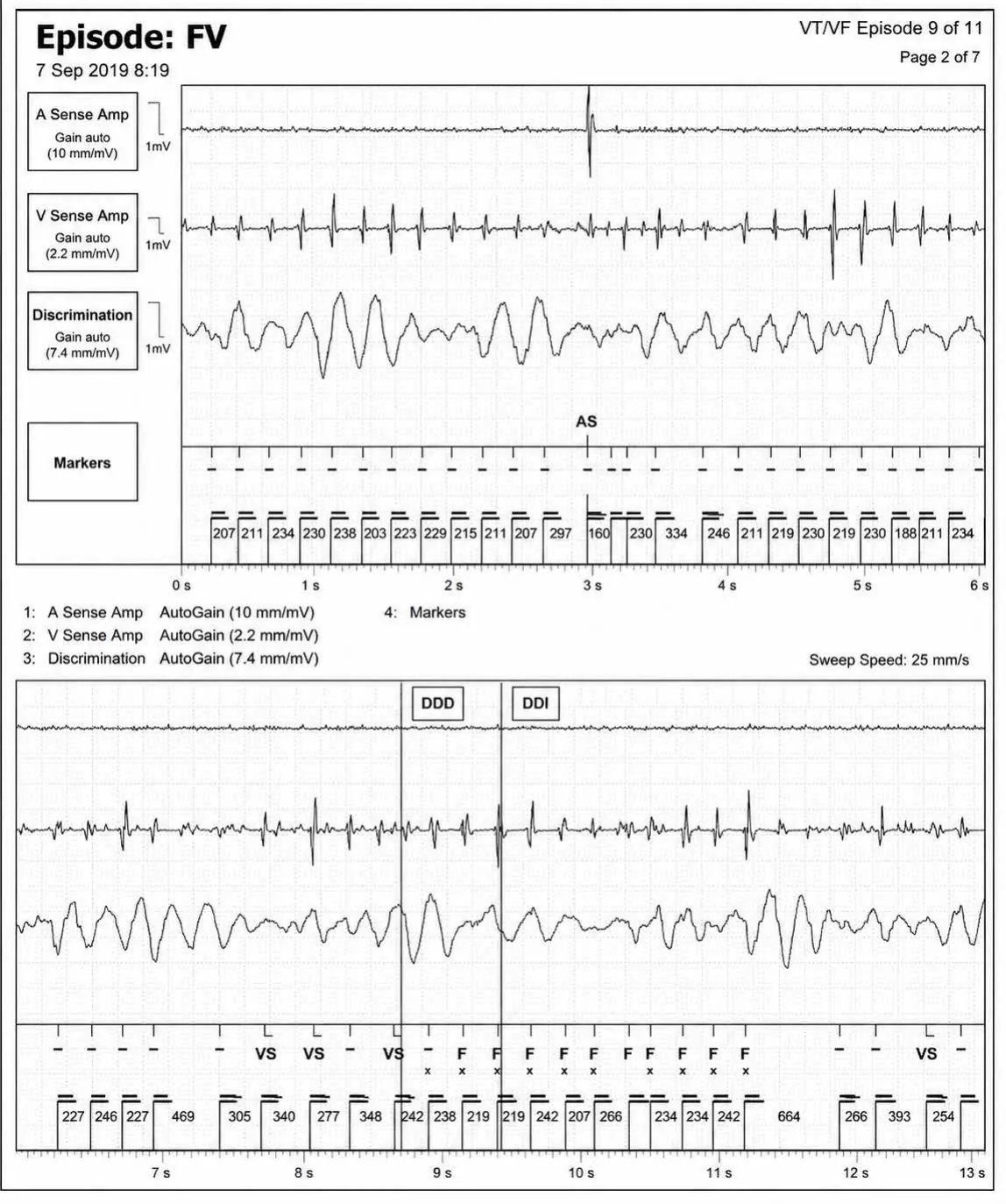 Acceleration of VT by anti-tachycardia pacing and high defibrillation threshold