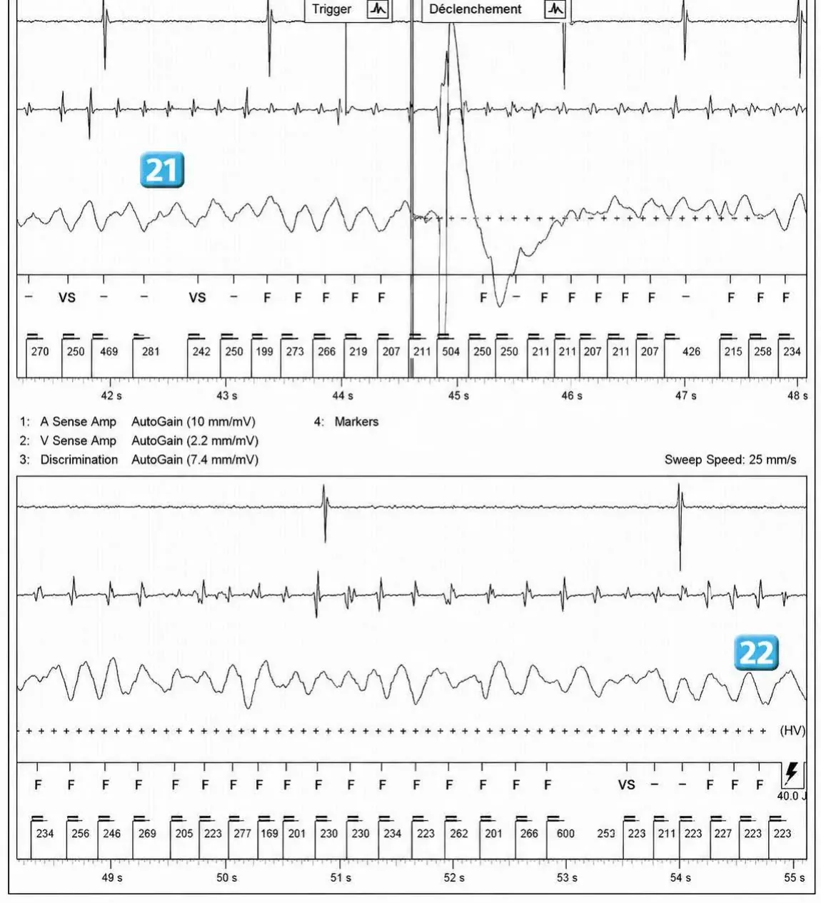 Acceleration of VT by anti-tachycardia pacing and high defibrillation threshold