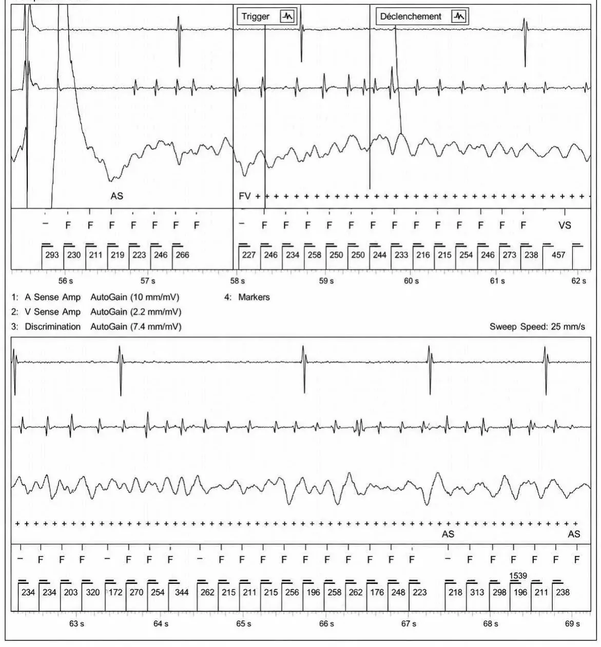 Acceleration of VT by anti-tachycardia pacing and high defibrillation threshold