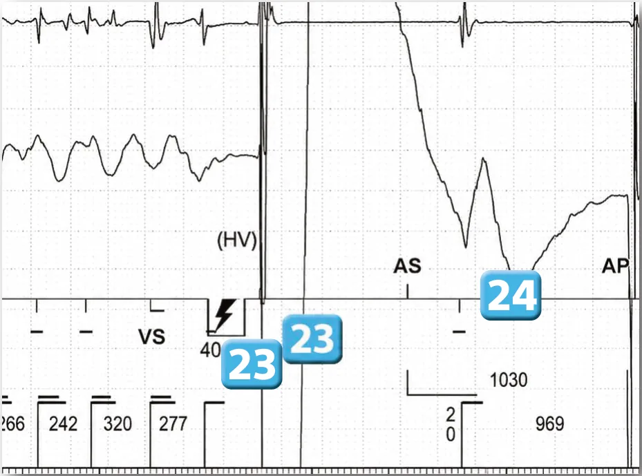 Acceleration of VT by anti-tachycardia pacing and high defibrillation threshold
