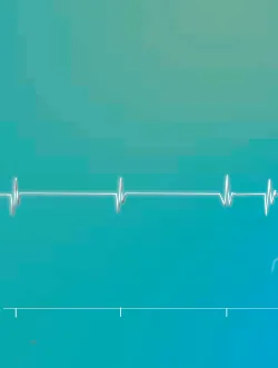 Acceleration of VT by anti-tachycardia pacing and high defibrillation threshold