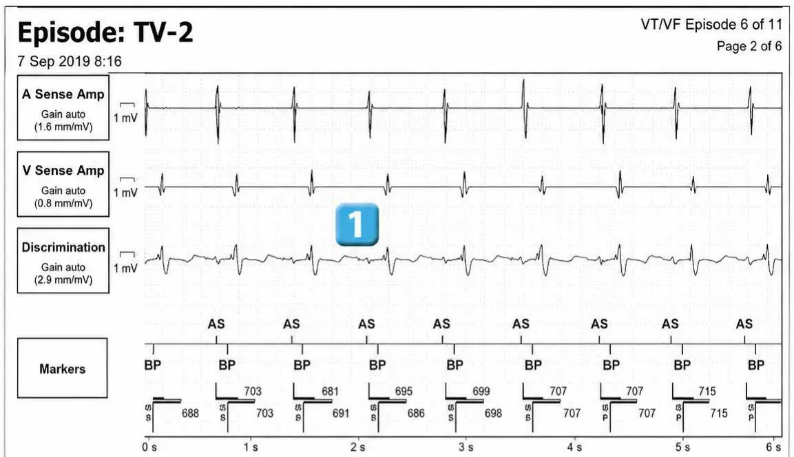 Abbott ICD electrogram, segment 1 of 12 — Acceleration of VT by anti-tachycardia pacing and high defibrillation threshold