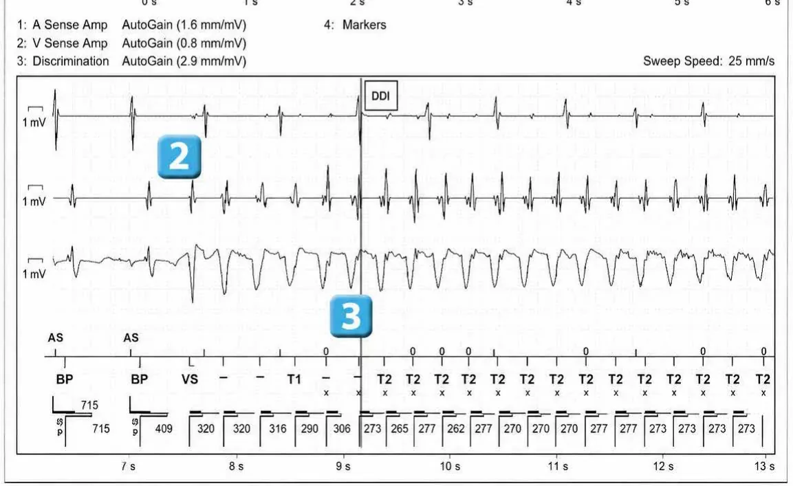 Abbott ICD electrogram, segment 2 of 12 — Acceleration of VT by anti-tachycardia pacing and high defibrillation threshold