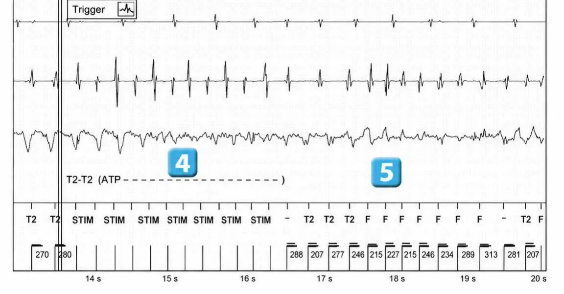 Abbott ICD electrogram, segment 3 of 12 — Acceleration of VT by anti-tachycardia pacing and high defibrillation threshold