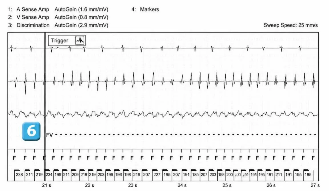 Abbott ICD electrogram, segment 4 of 12 — Acceleration of VT by anti-tachycardia pacing and high defibrillation threshold