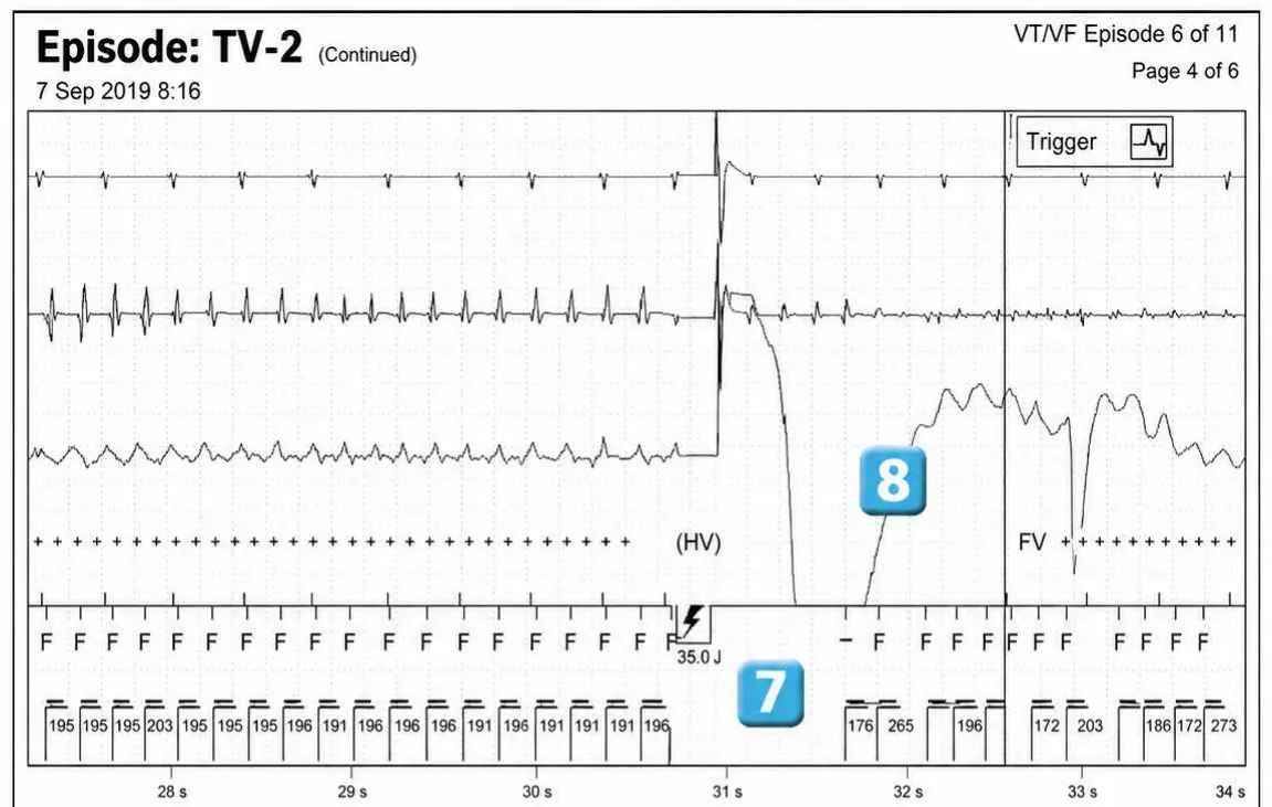 Abbott ICD electrogram, segment 5 of 12 — Acceleration of VT by anti-tachycardia pacing and high defibrillation threshold