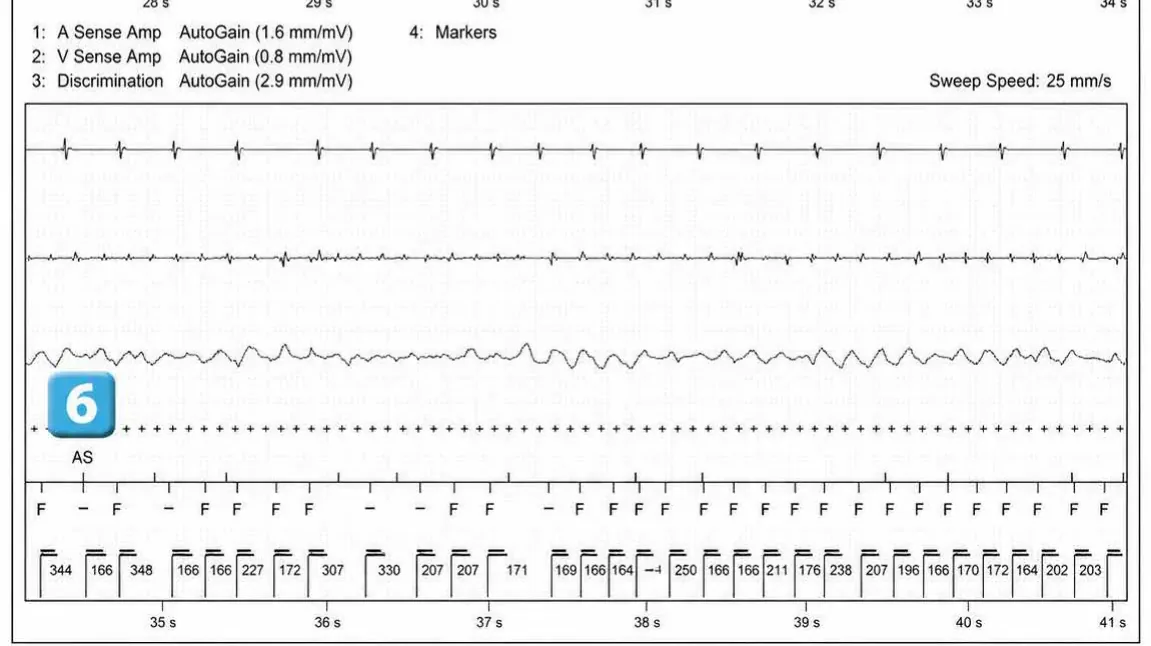 Abbott ICD electrogram, segment 6 of 12 — Acceleration of VT by anti-tachycardia pacing and high defibrillation threshold