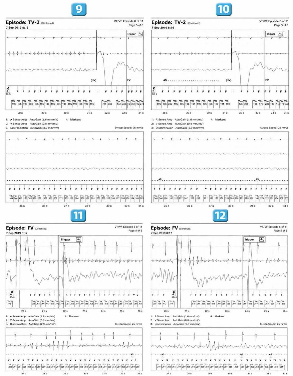 Abbott ICD electrogram, segment 7 of 12 — Acceleration of VT by anti-tachycardia pacing and high defibrillation threshold