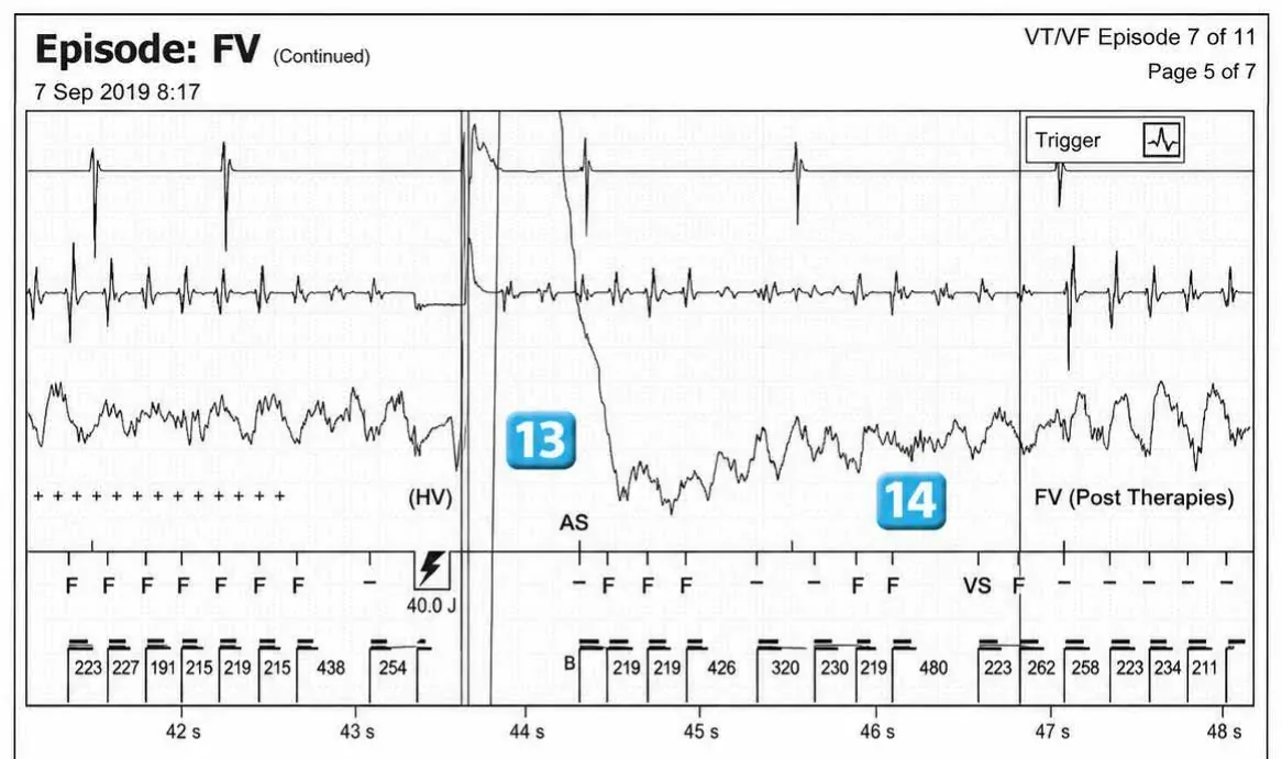 Abbott ICD electrogram, segment 8 of 12 — Acceleration of VT by anti-tachycardia pacing and high defibrillation threshold