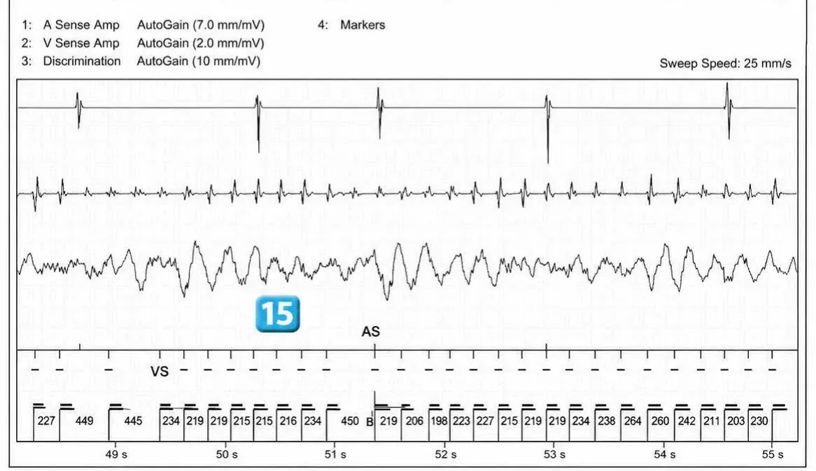 Abbott ICD electrogram, segment 9 of 12 — Acceleration of VT by anti-tachycardia pacing and high defibrillation threshold