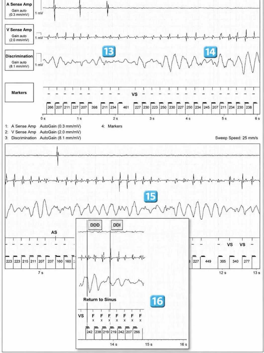 Abbott ICD electrogram, segment 10 of 12 — Acceleration of VT by anti-tachycardia pacing and high defibrillation threshold