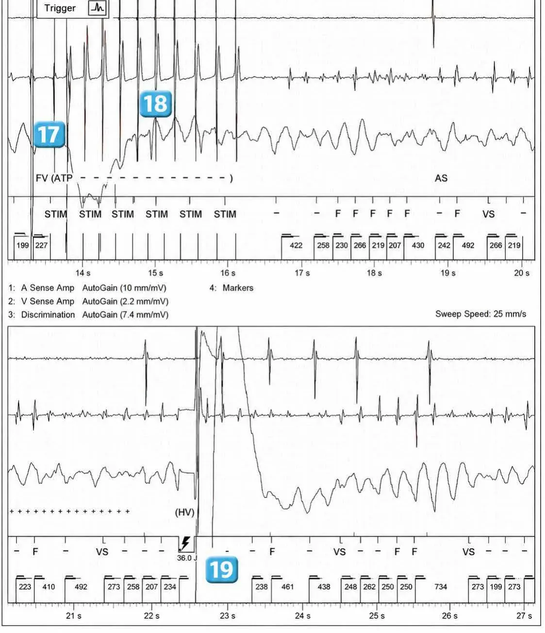 Abbott ICD electrogram, segment 11 of 12 — Acceleration of VT by anti-tachycardia pacing and high defibrillation threshold