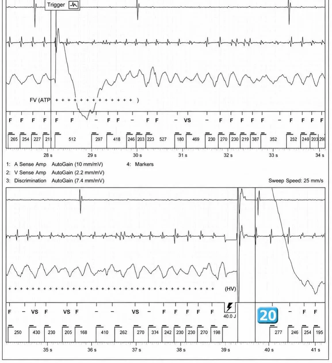 Abbott ICD electrogram, segment 12 of 12 — Acceleration of VT by anti-tachycardia pacing and high defibrillation threshold