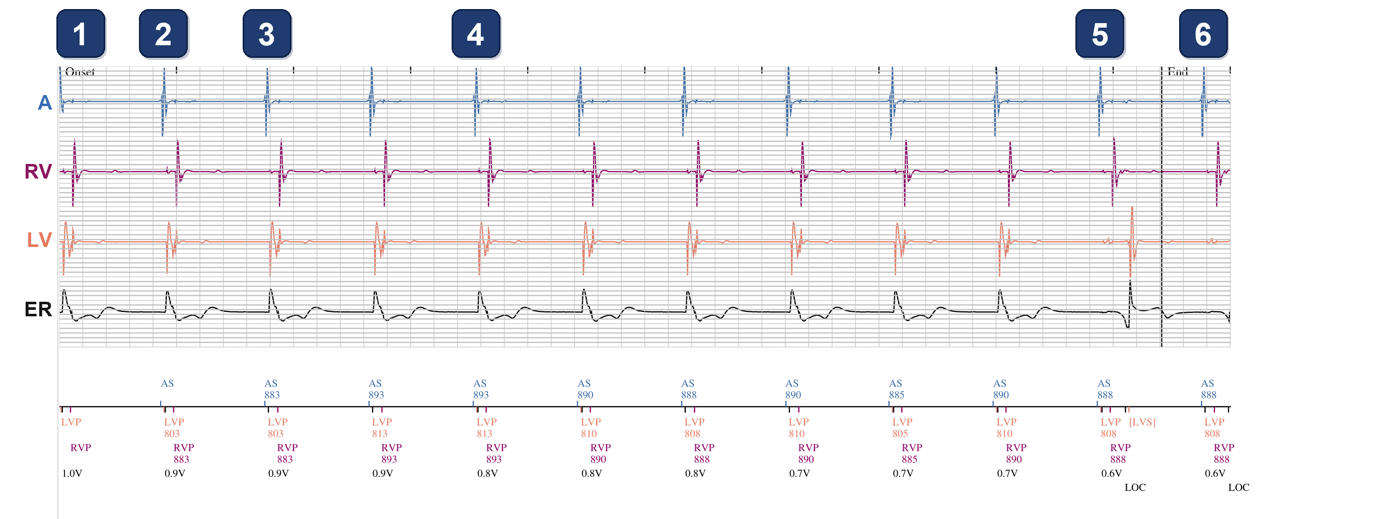 Boston Scientific CRT electrogram, segment 1/1 — Ambulatory PaceSafe LV threshold test