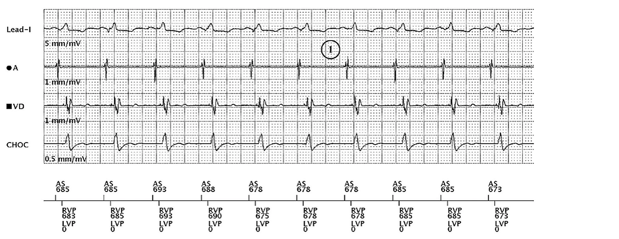 Boston Scientific CRT electrogram, segment 1/3 — Non-responder despite 100% BiV pacing