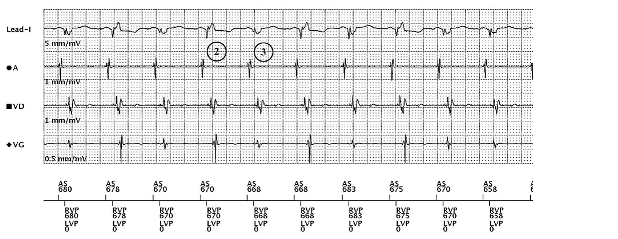 Boston Scientific CRT electrogram, segment 2/3 — Non-responder despite 100% BiV pacing