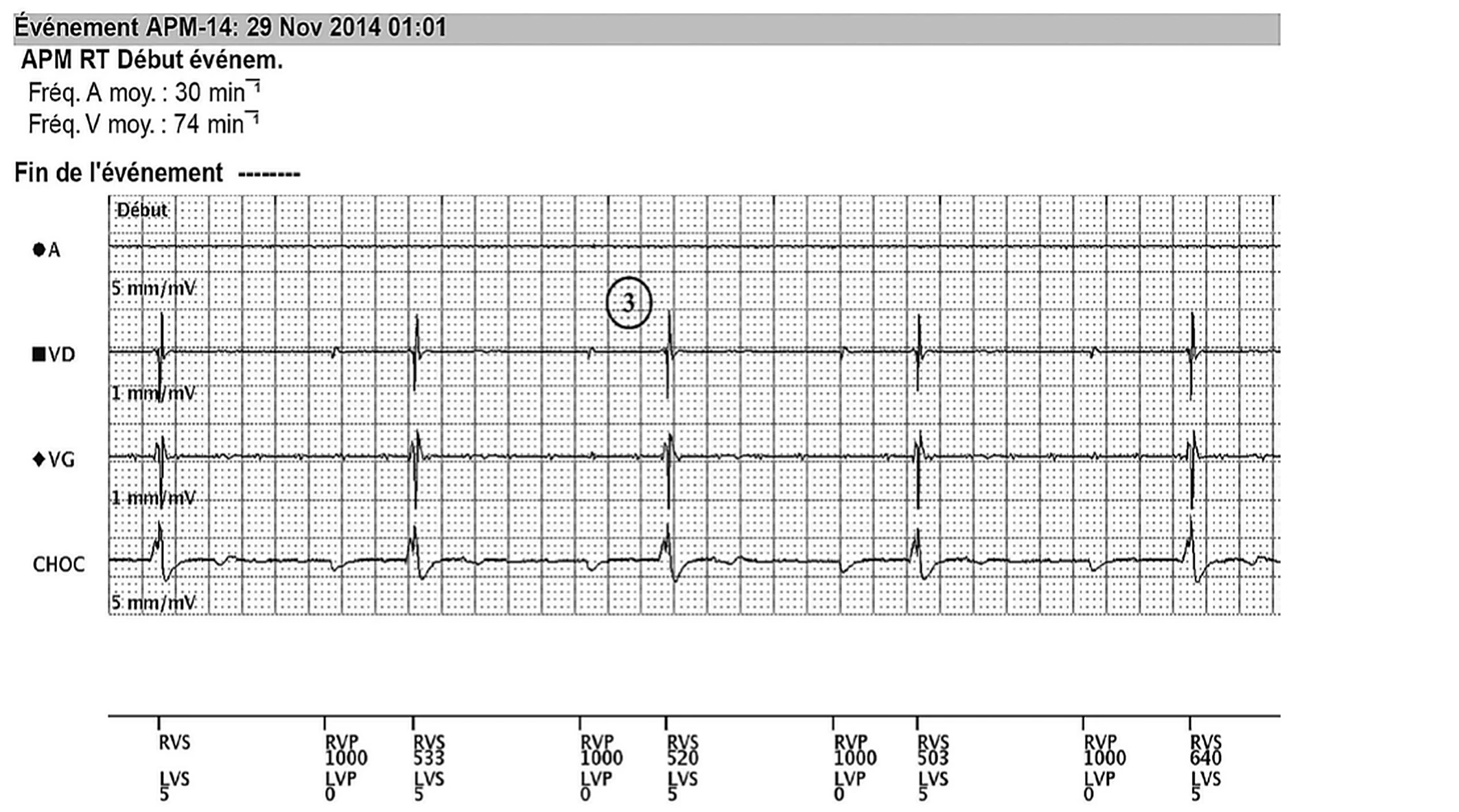 Boston Scientific CRT electrogram, segment 3/8 — Remote real-time EGM in a dialysis patient