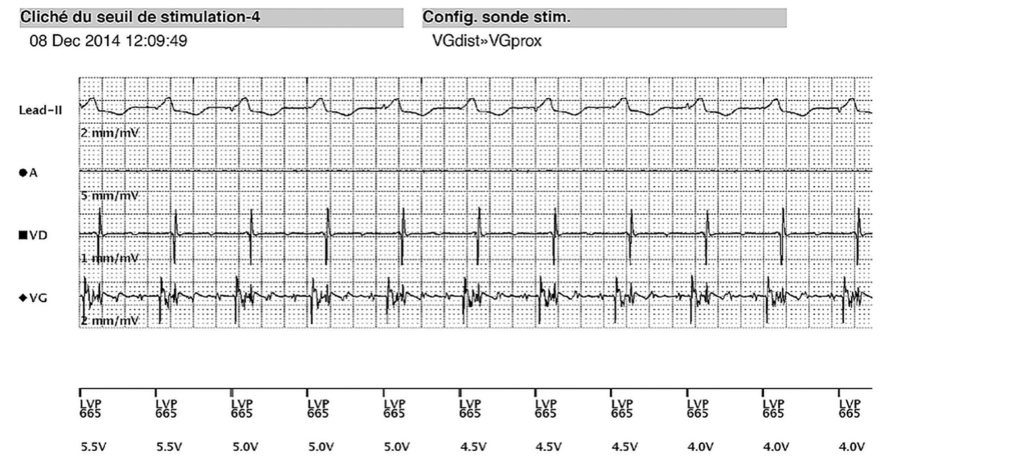 Boston Scientific CRT electrogram, segment 5/8 — Remote real-time EGM in a dialysis patient