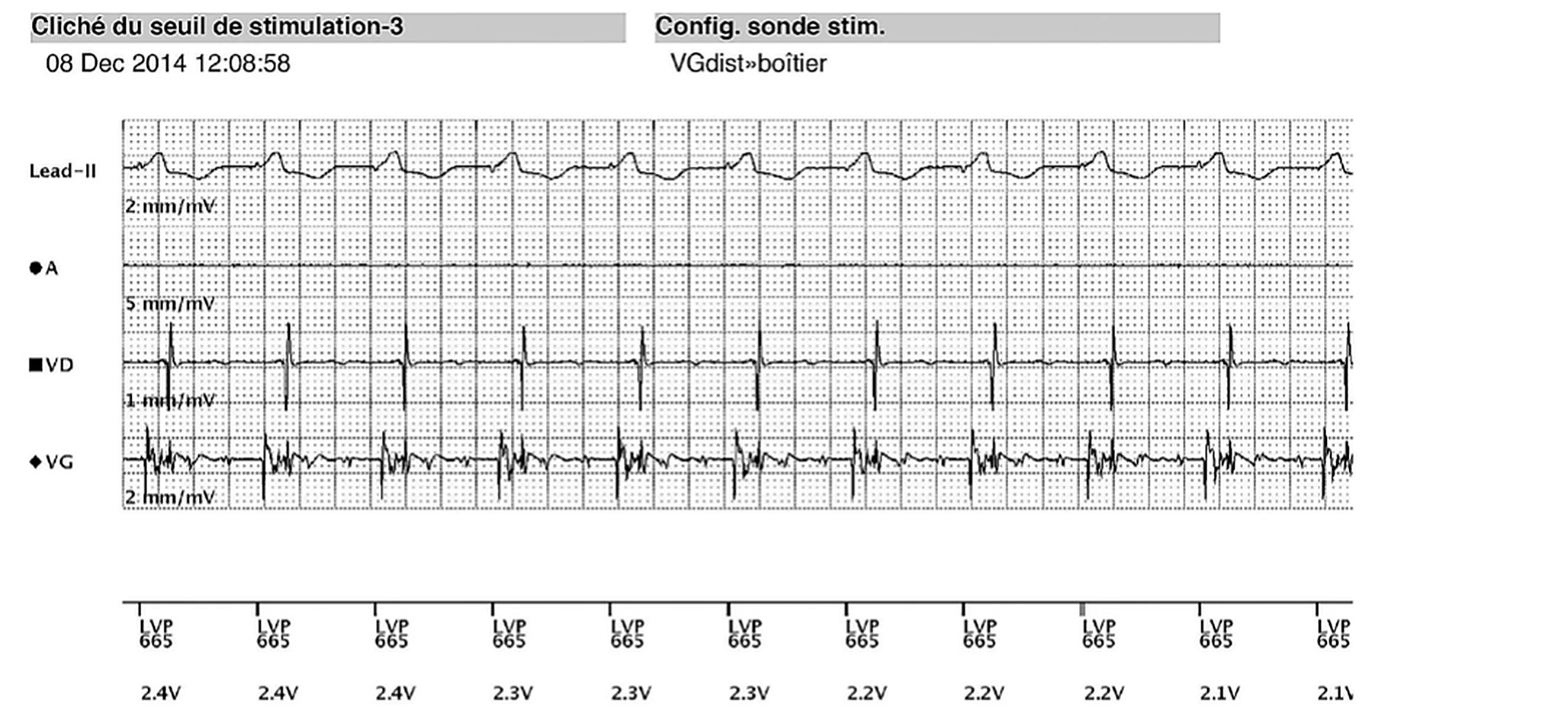 Boston Scientific CRT electrogram, segment 7/8 — Remote real-time EGM in a dialysis patient