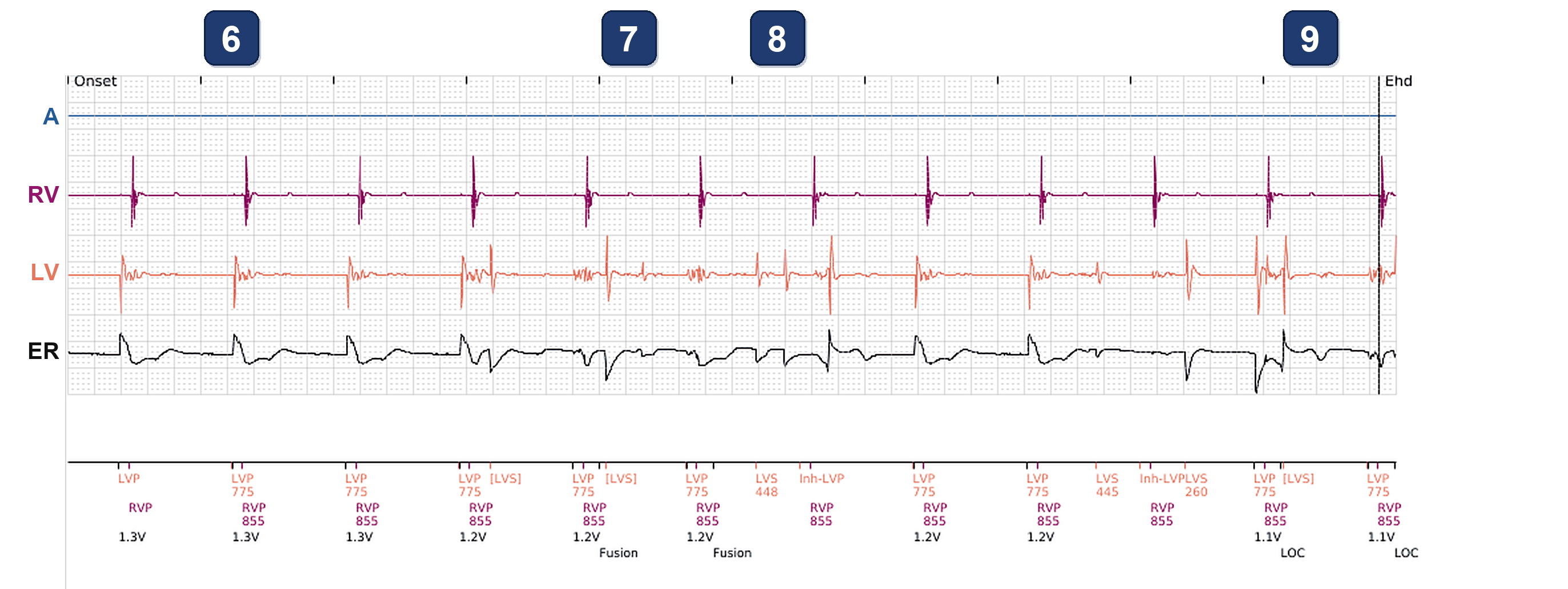 Boston Scientific CRT electrogram, segment 4/4 — LV impedance alert and an odd PaceSafe LV test