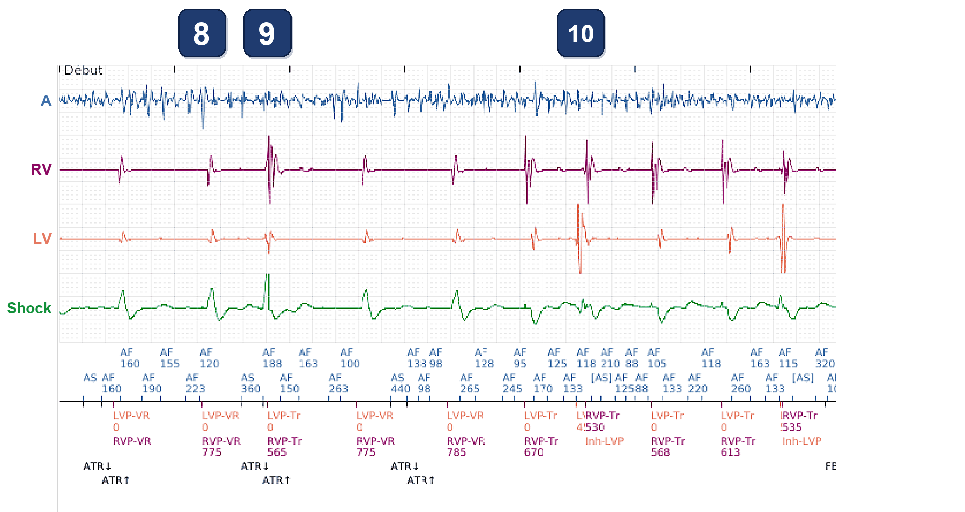 Boston Scientific CRT electrogram, segment 5/5 — BiV Trigger in AF, and the same patient 15 months later