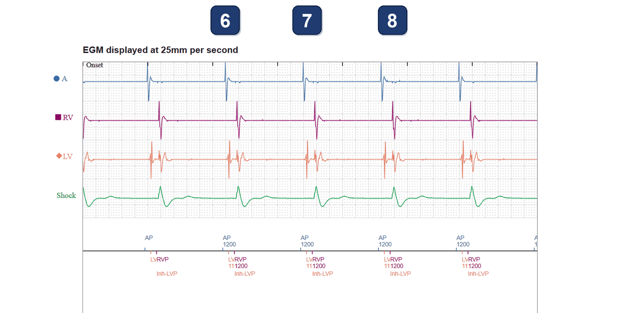Boston Scientific CRT electrogram, segment 3/3 — CRT-D with a conduction-system lead: the LV trends jump