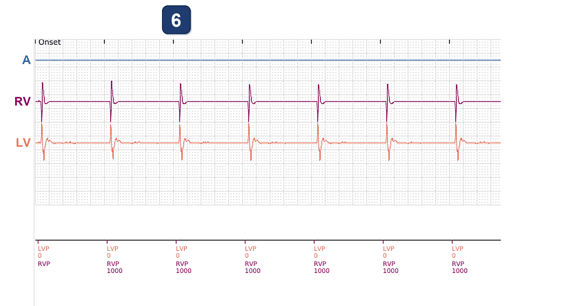 Boston Scientific CRT electrogram, segment 3/7 — LV impedance out-of-range alert near battery end of life