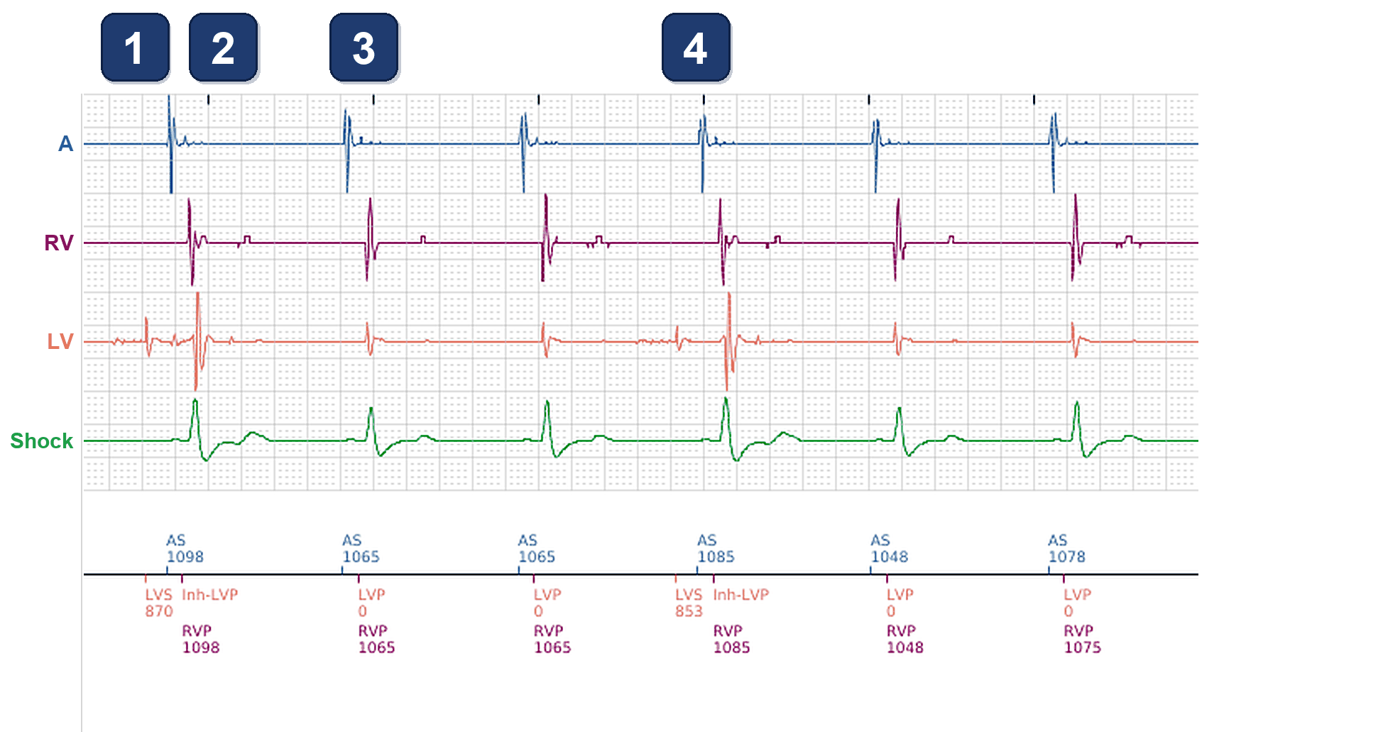 Boston Scientific CRT electrogram, segment 1/4 — Intermittent RV-only paced beats in a RESONATE CRT-D
