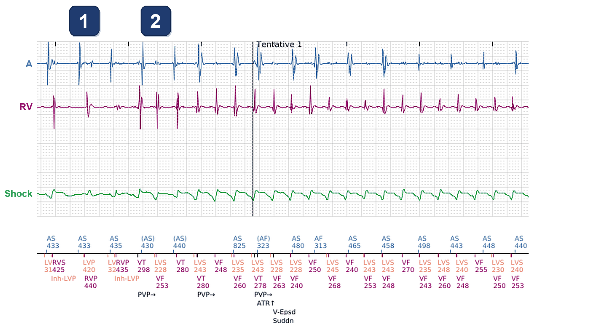 Boston Scientific CRT electrogram, segment 1/3 — CRT-D shock: and what about the LV channel?