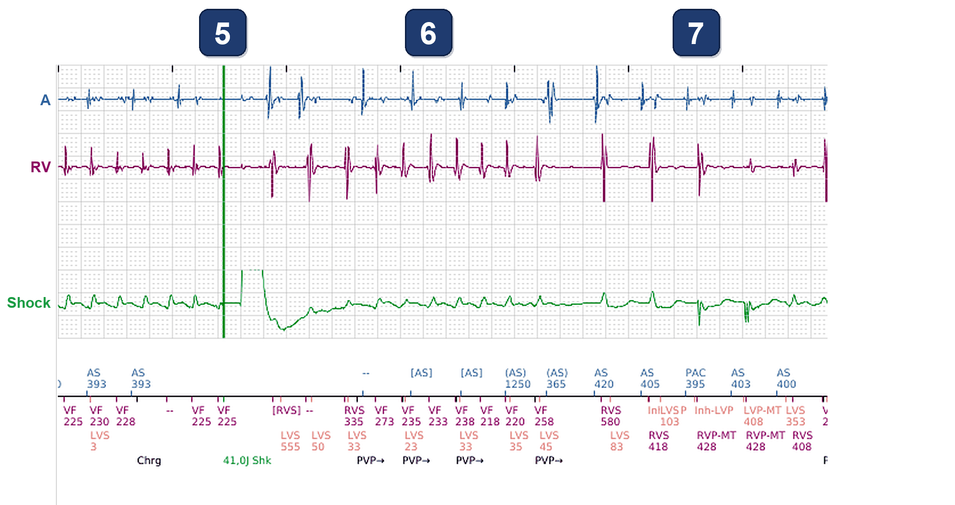 Boston Scientific CRT electrogram, segment 3/3 — CRT-D shock: and what about the LV channel?